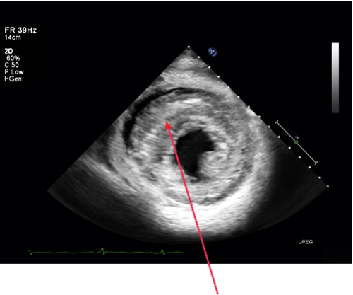 attr-amyloid-heart